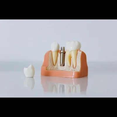 Dental implant consultation